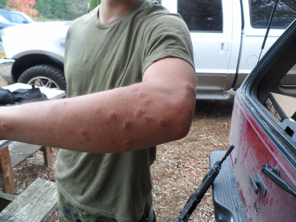 Airsoft BBs can leave some pretty nasty welts behind!